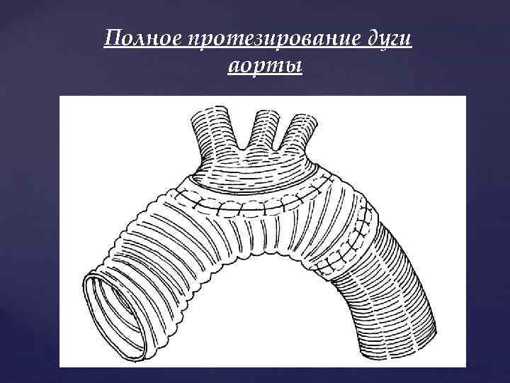 Полное протезирование дуги аорты 