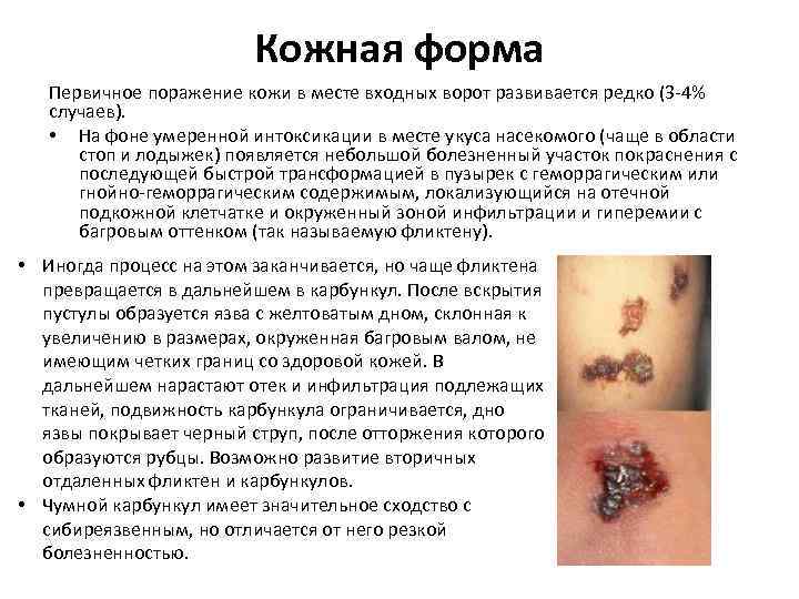 Кожная форма Первичное поражение кожи в месте входных ворот развивается редко (3 -4% случаев).