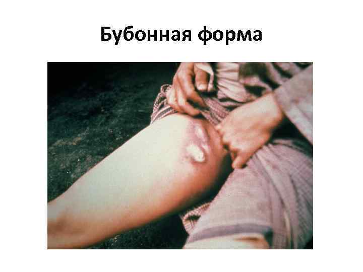 Бубонная форма 