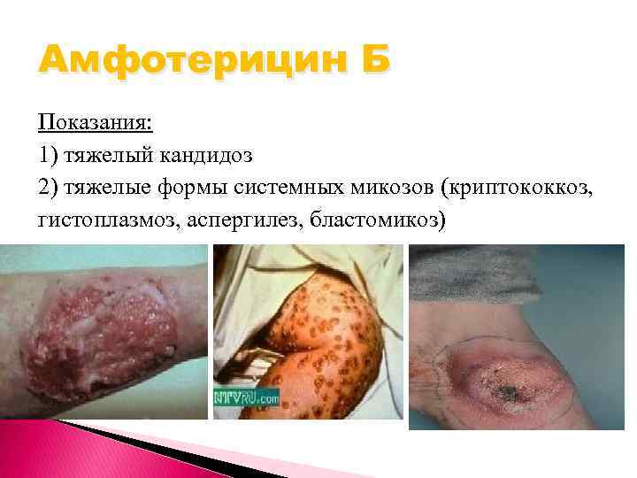 Амфотерицин Б Показания: 1) тяжелый кандидоз 2) тяжелые формы системных микозов (криптококкоз, гистоплазмоз, аспергилез,