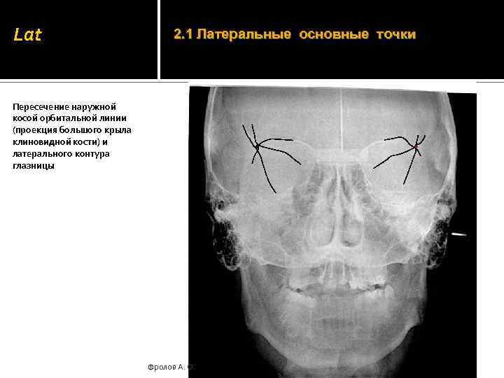 Lat 2. 1 Латеральные основные точки Пересечение наружной косой орбитальной линии (проекция большого крыла