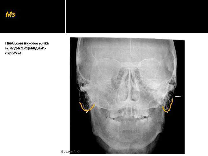 Ms Наиболее нижняя точка контура сосцевидного отростка Фролов А. О. 
