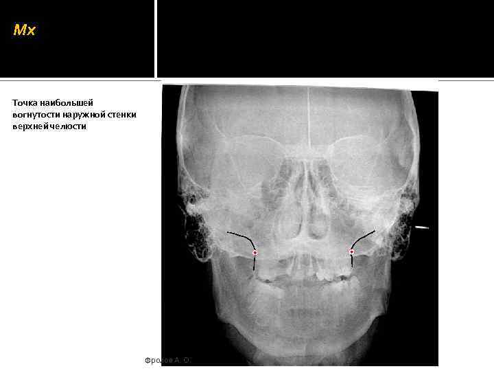 Mx Точка наибольшей вогнутости наружной стенки верхней челюсти Фролов А. О. 
