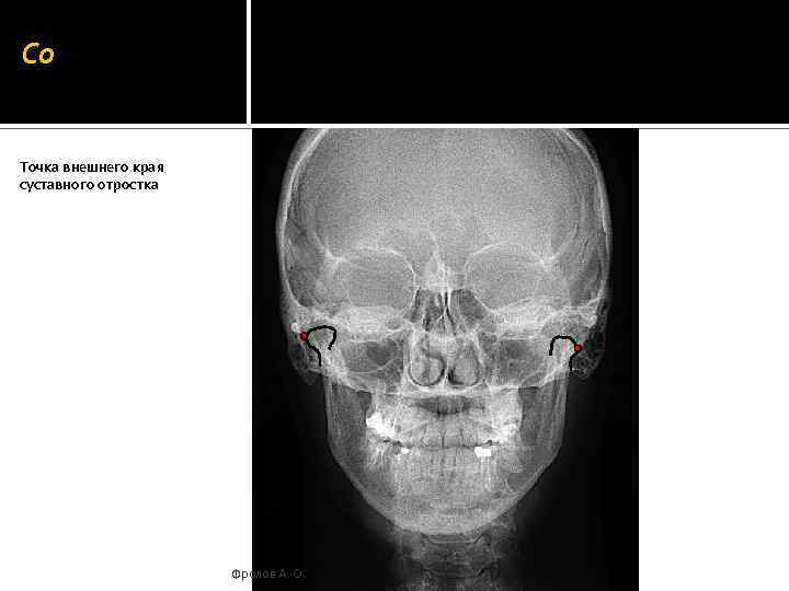 Co Точка внешнего края суставного отростка Фролов А. О. 
