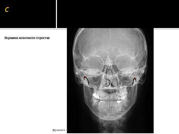 C Вершина венечного отростка Фролов А. О. 