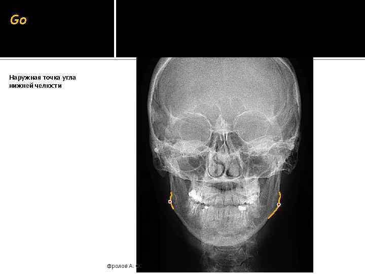 Go Наружная точка угла нижней челюсти Фролов А. О. 