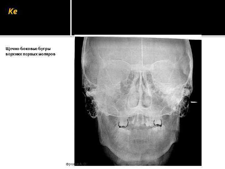 Ke Щечно-боковые бугры верхних первых моляров Фролов А. О. 