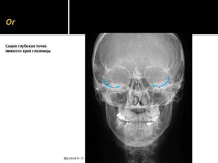 Or Самая глубокая точка нижнего края глазницы Фролов А. О. 