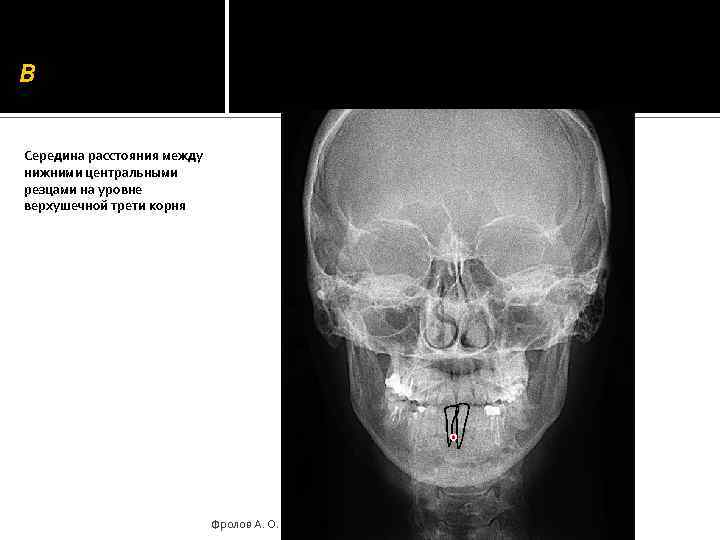 B Середина расстояния между нижними центральными резцами на уровне верхушечной трети корня Фролов А.
