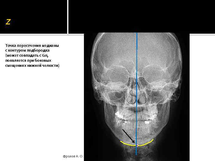 Z Точка пересечения медианы с контуром подбородка (может совпадать с Gn, появляется при боковых