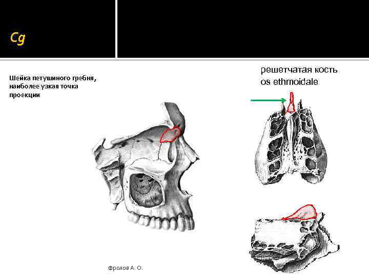 Cg решетчатая кость os ethmoidale Шейка петушиного гребня, наиболее узкая точка проекции Фролов А.