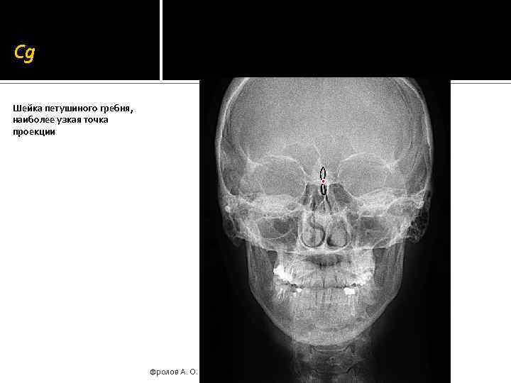 Cg Шейка петушиного гребня, наиболее узкая точка проекции Фролов А. О. 