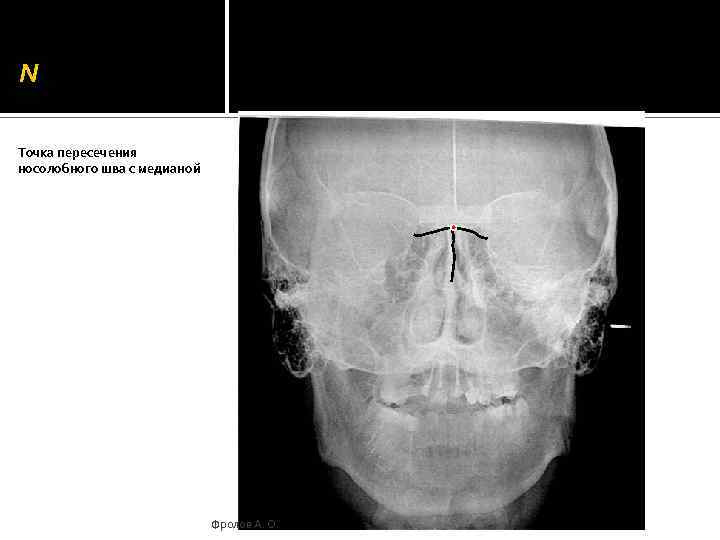 N Точка пересечения носолобного шва с медианой Фролов А. О. 