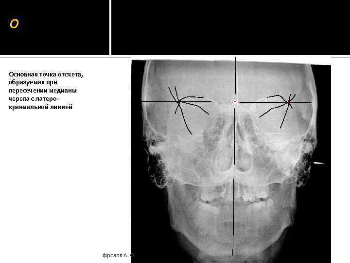 О Основная точка отсчета, образуемая при пересечении медианы черепа с латерокраниальной линией Фролов А.