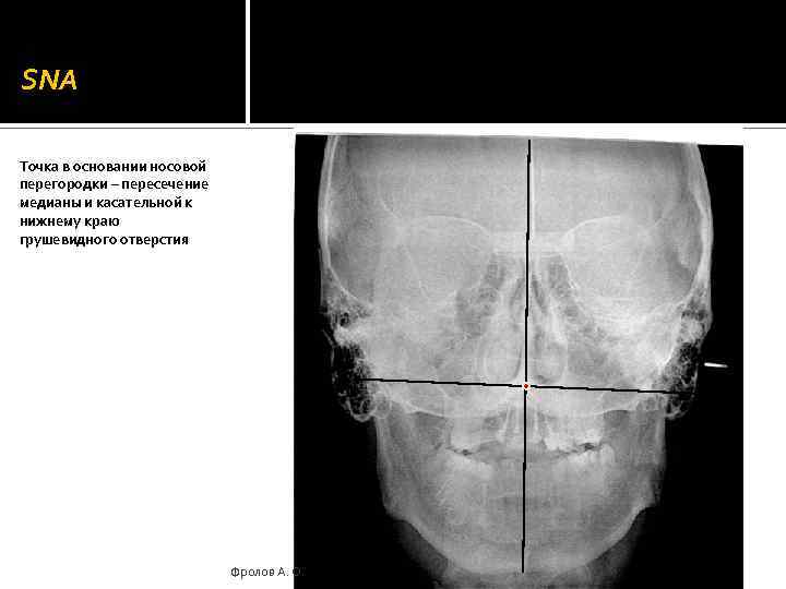 SNA Точка в основании носовой перегородки – пересечение медианы и касательной к нижнему краю
