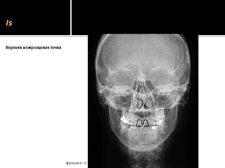 Is Верхняя межрезцовая точка Фролов А. О. 