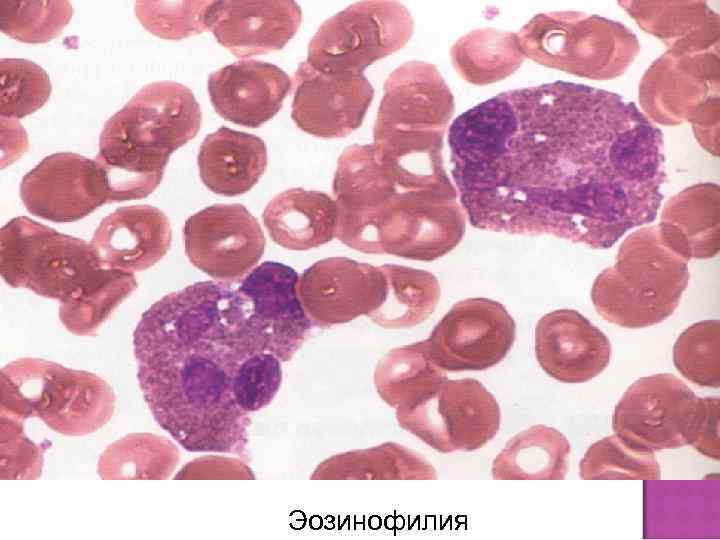 Эозинофилия 