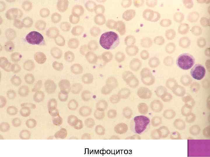 Лимфоцитоз 