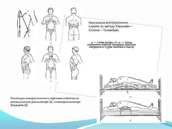 Наложение экстснзионного корсета по методу Юмашева— Силина— Таламбума а — точки опоры; б—е —