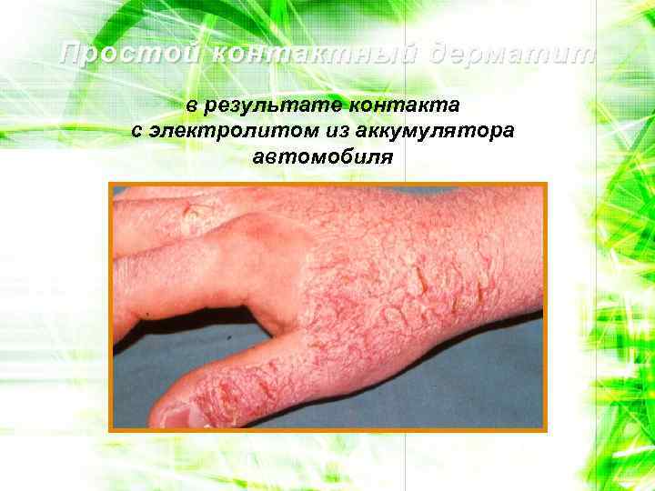 Простой контактный дерматит в результате контакта с электролитом из аккумулятора автомобиля 