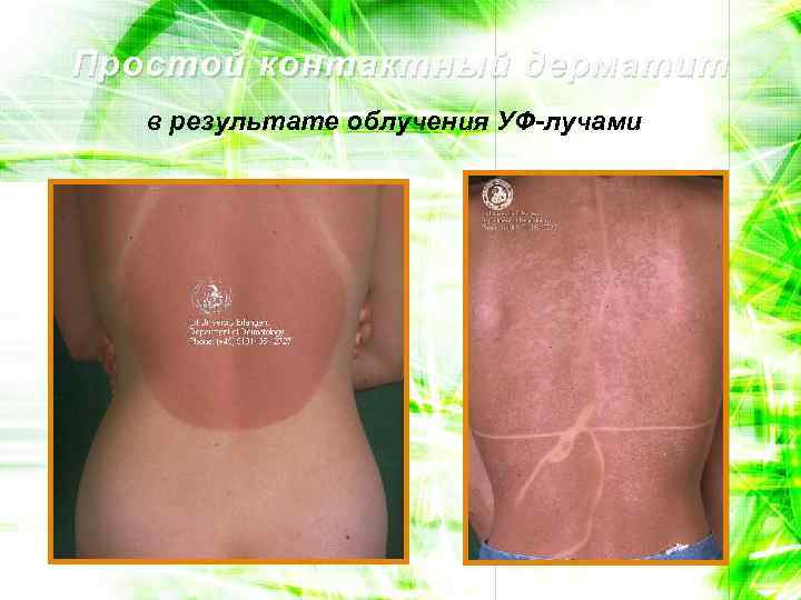 Простой контактный дерматит в результате облучения УФ-лучами 