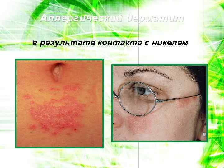 Аллергический дерматит в результате контакта с никелем 