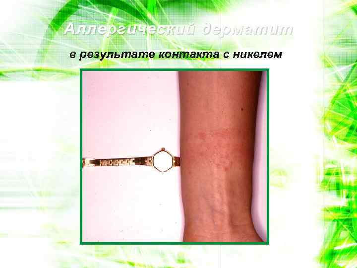 Аллергический дерматит в результате контакта с никелем 