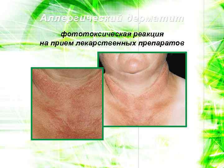 Аллергический дерматит фототоксическая реакция на прием лекарственных препаратов 