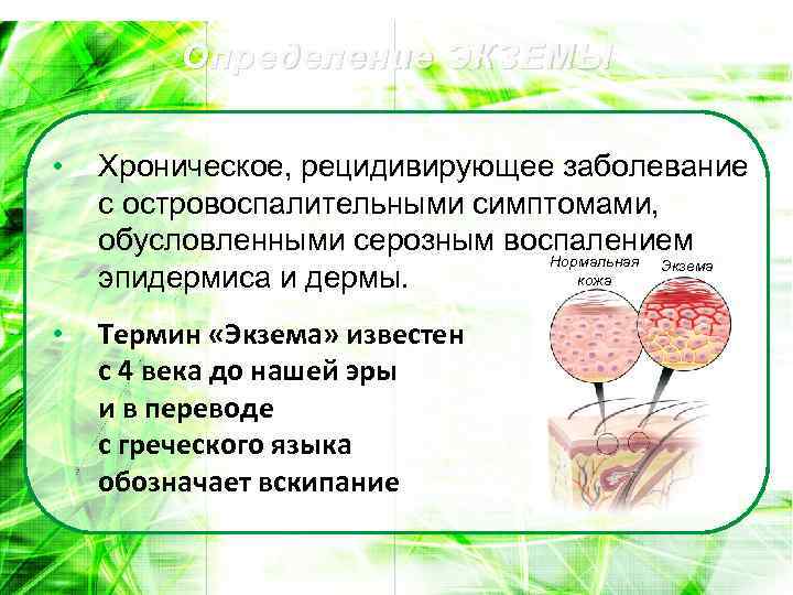 Определение ЭКЗЕМЫ • Хроническое, рецидивирующее заболевание с островоспалительными симптомами, обусловленными серозным воспалением Нормальная Экзема