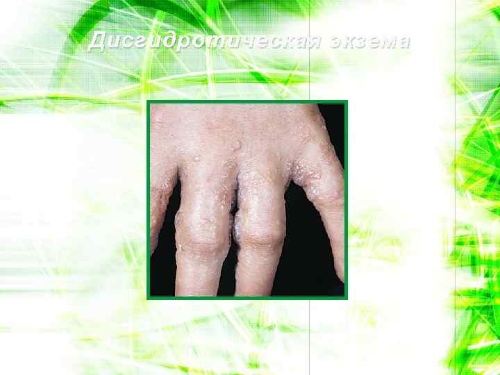 Дисгидротическая экзема 