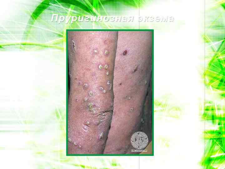 Пруригинозная экзема 