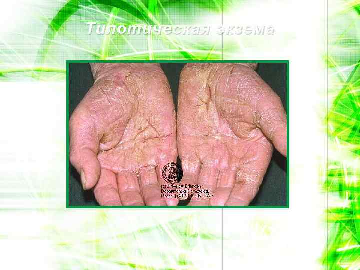 Тилотическая экзема 