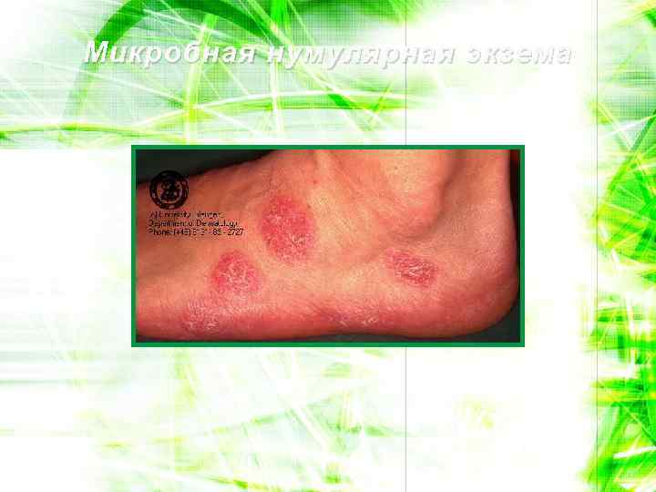 Микробная нумулярная экзема 