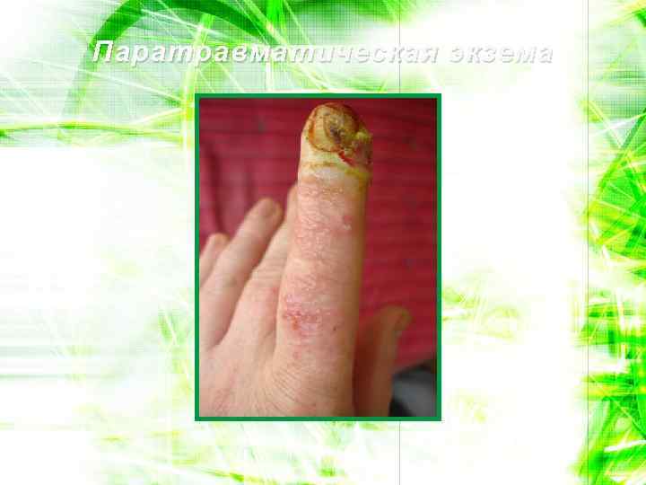 Паратравматическая экзема 