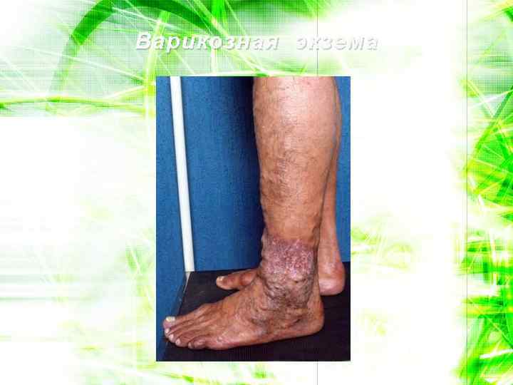 Варикозная экзема 