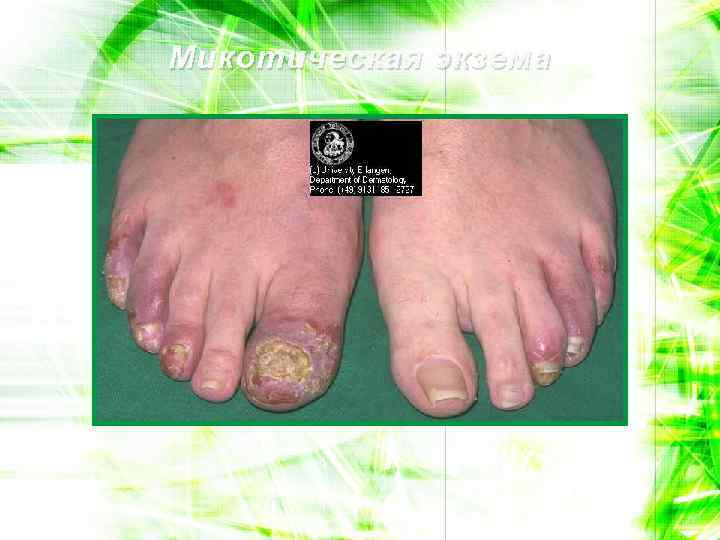 Микотическая экзема 