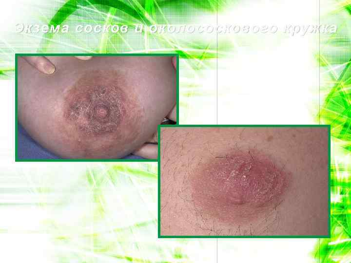 Экзема сосков и околососкового кружка 