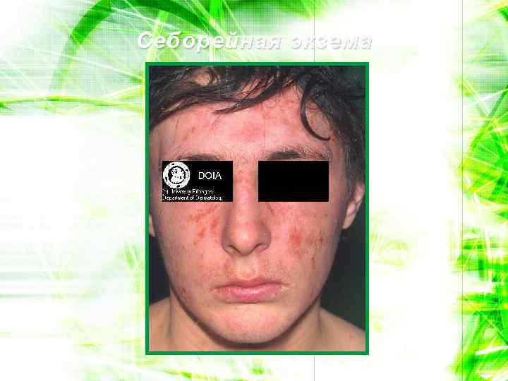 Себорейная экзема 