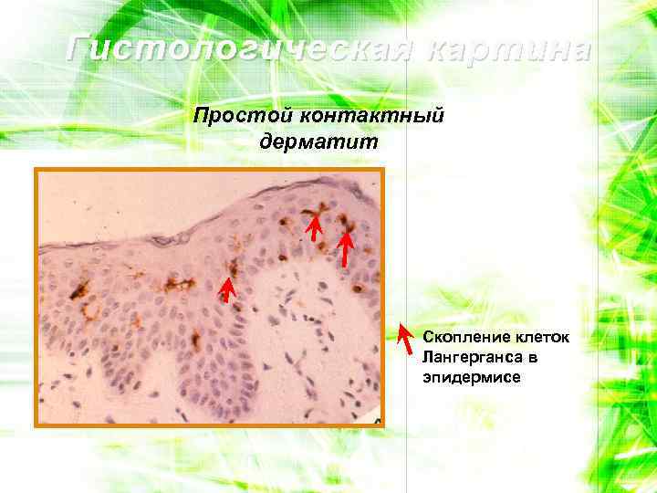 Гистологическая картина Простой контактный дерматит Скопление клеток Лангерганса в эпидермисе 
