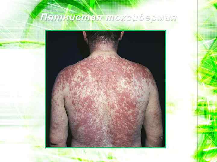 Пятнистая токсидермия 