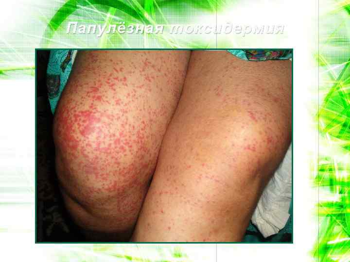 Папулёзная токсидермия 