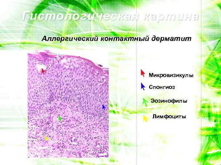 Гистологическая картина Аллергический контактный дерматит Микровизикулы Спонгиоз Эозинофилы Лимфоциты 