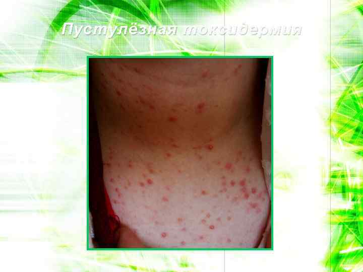 Пустулёзная токсидермия 