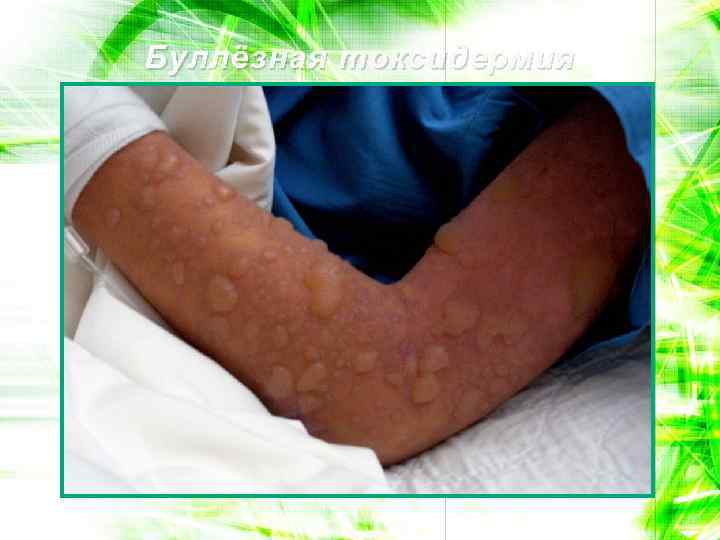 Буллёзная токсидермия 