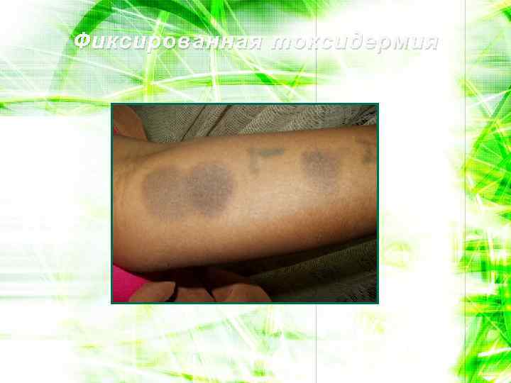 Фиксированная токсидермия 
