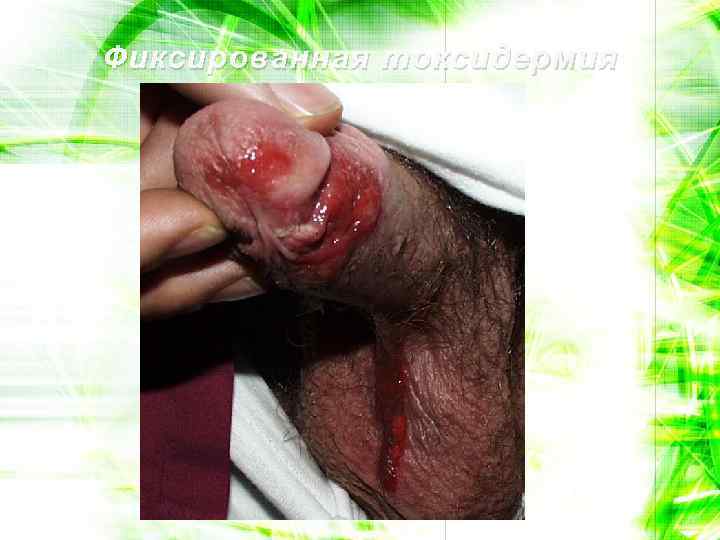 Фиксированная токсидермия 