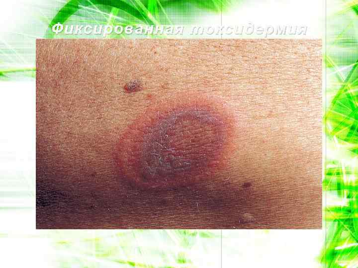 Фиксированная токсидермия 