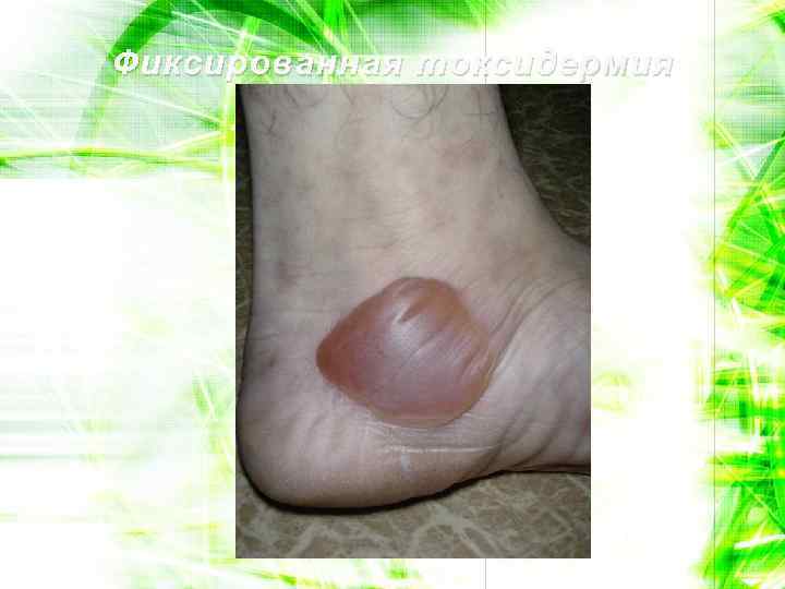 Фиксированная токсидермия 