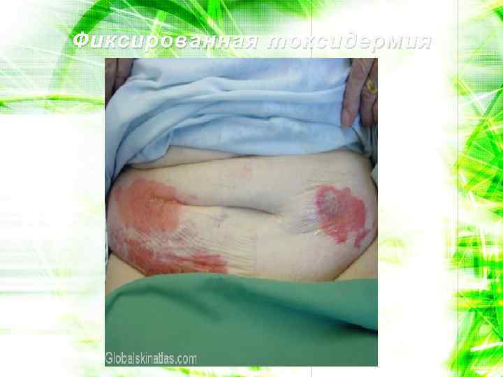 Фиксированная токсидермия 