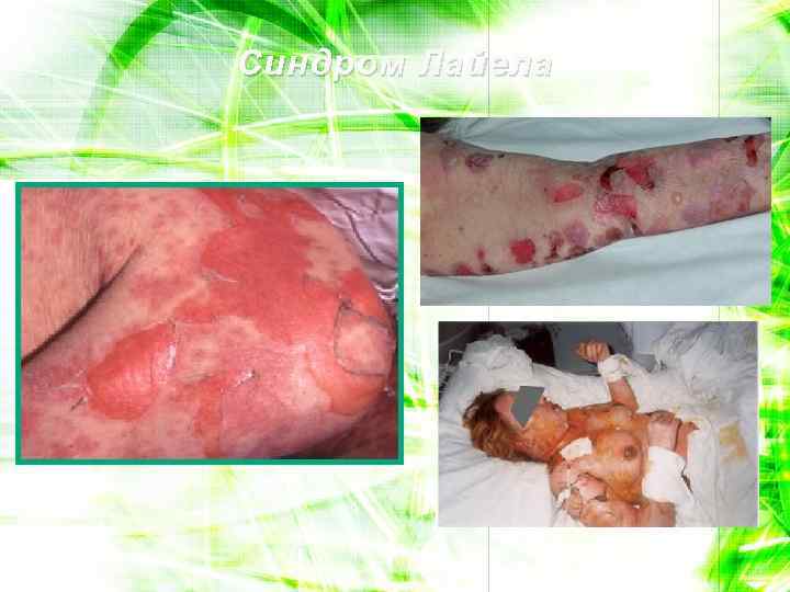 Синдром Лайела 